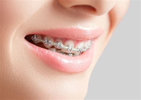 Benefits Of A Full Braces Treatment │german Dental Clinic