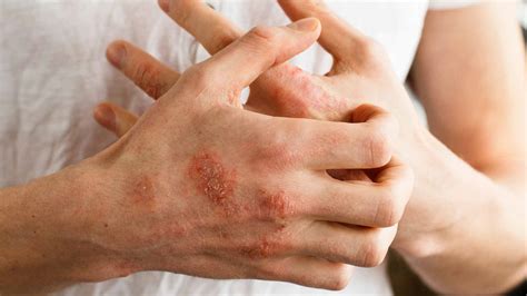7 Best Natural Home Remedies And Treatment For Eczema And Psoriasis Relief