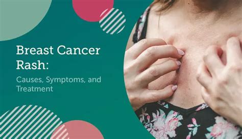 Breast Cancer Rash Causes Symptoms And Treatment Mybcteam