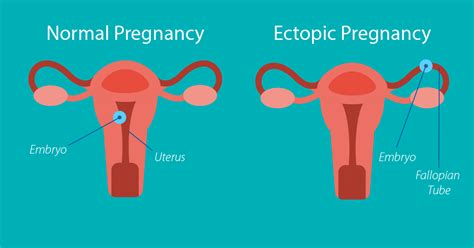 Managing An Ectopic Pregnancy St Lukes Health