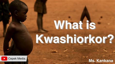 Describe A Child Suffering From Kwashiorkor Askworksheet