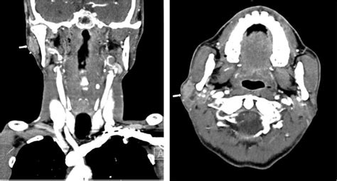 Ct Neck With Contrast Was Performed An Approximately 12 Cm