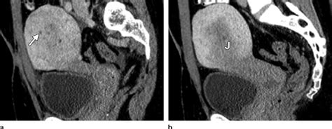 A B Sagittal Contrast Enhanced Ct Images Obtained During The Portal
