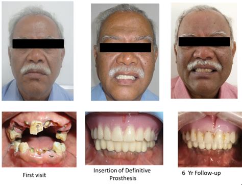 Pre Operative Post Insertion Of Definitive Prosthesis And Six Year