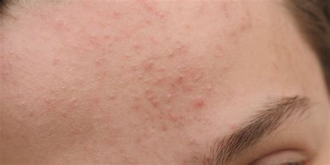 Subclinical Acne Definition Causes And How To Treat Tiege Hanley