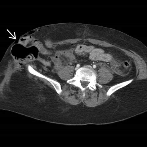 Ct Scan Of Traumatic Abdominal Wall Hernia As A Result Of A Handlebar