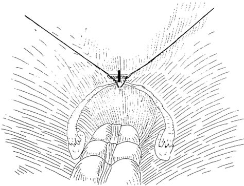 Laparoscopic Creation Of A Neovagina In Mayer Rokitansky Kuster Hauser
