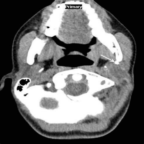 Cureus Parotid Sialolithiasis In A 17 Year Old Girl