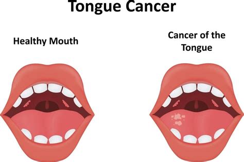 Decoding Bumps On The Back Of The Tongue