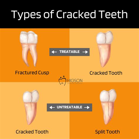 Cracked Tooth Repair Common Causes And Fixes For Cracked Teeth