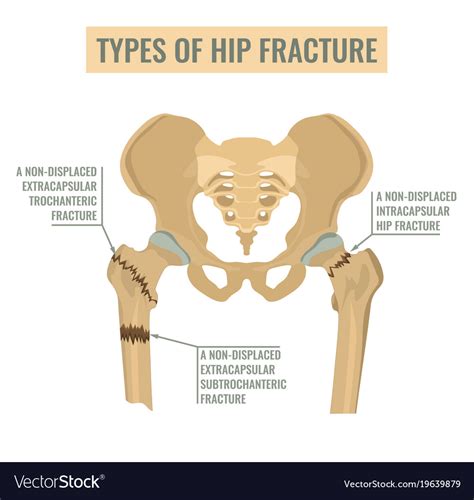 Types Hip Fracture Royalty Free Vector Image Vectorstock