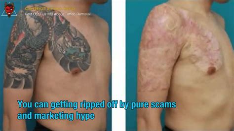Price Of Laser Tattoo Removal Everything You Must To Learn About