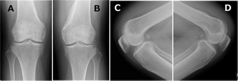 Postoperative Anteroposterior And Lateral Radiographs Of Both Knees