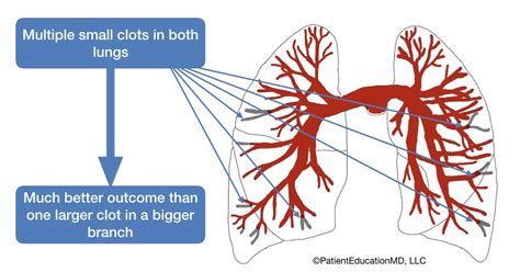 Blood clots most often start in the legs and travel up through the right side of the heart and into the lungs. Symptoms of blood clots in the lungs - PatientEducationMD