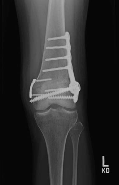 Distal Femoral Osteotomy Sparks Carson Nv Femur Fracture Reno Nv