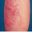 Unusual Papular Lesions In A Healthy Man  Dermatology JAMA