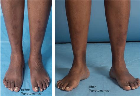 Showing Pretibial Myxedema Before And After Teprotumumab Download Scientific Diagram