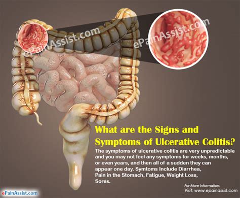 What Are The Signs And Symptoms Of Ulcerative Colitis
