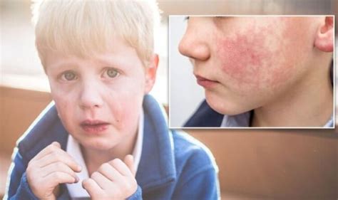 Slapped Cheek Syndrome Is Common In Children Three Symptoms To Look