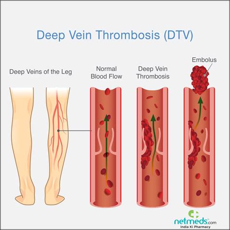Deep Vein Thrombosis DVT Symptoms Causes And 46 OFF