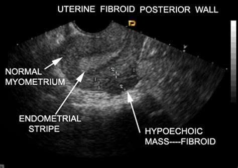 Wk 3 L 2 Hypoechoic Fibroid Ultrasound Sonography Diagnostic Medical