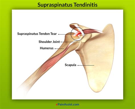 Supraspinatus Tendinitis Treatment Causes Symptoms Prognosis