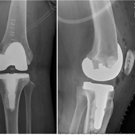 Postoperative Radiographs Of Case 1 Showing A Well Fixed And Aligned