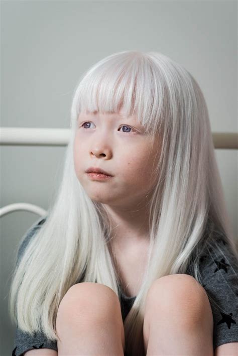 My Experience Adopting A Child With Albinism Albino Girl Albinism