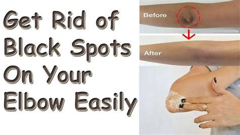 How To Get Rid Of Dark Elbows And Knees In 7 Days Health And Beauty