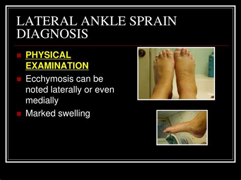 Ppt Ankle Lateral Ligament Injuries And Reconstruction Powerpoint