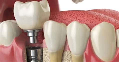 ¿cómo Se Ponen Los Implantes Dentales Explicado Paso A Paso