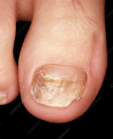 Fungal Nail Infection Stock Image C0500823 Science Photo Library