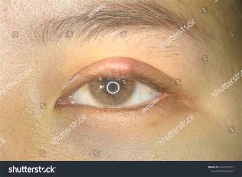 Close Stye Hordeolum Chalazion Eyelid Infection Stock Photo 1687269913