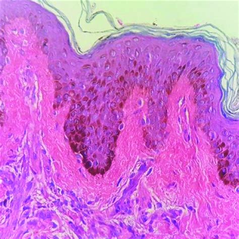 Acanthosis With Increased Basal Cell Layer Pigmentation H And E 400×