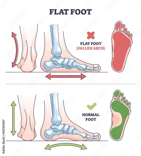 Vecteur Stock Flat Foot Pathology With Fallen And Normal Arch