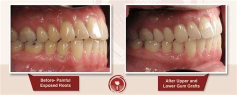 Gum Disease Treatment Smile Gallery Ramsey A Amin Dds