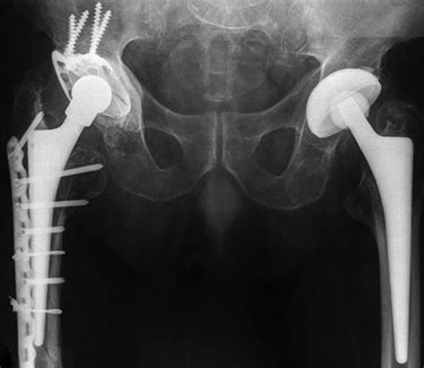 Late Peri Prosthetic Femoral Fracture As A Major Mode Of Failure In