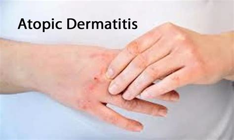 Severe Atopic Dermatitis Associated With Learning Disability In