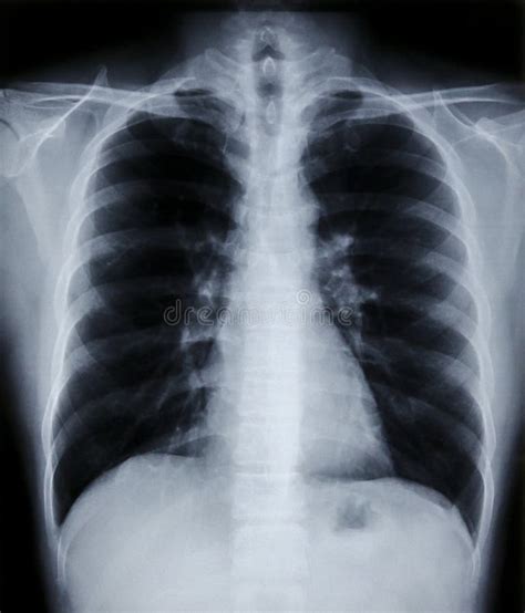 X Ray Image Of Human Chest And Pulmonary For A Medical Diagnosis Stock