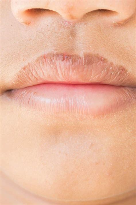 How To Get Rid Of Chapped Lips 6 Ways