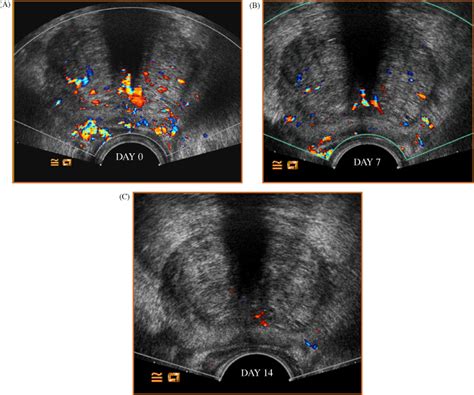 Dutasteride Prior To Contrast Enhanced Colour Doppler Ultrasound Prostate Biopsy Increases