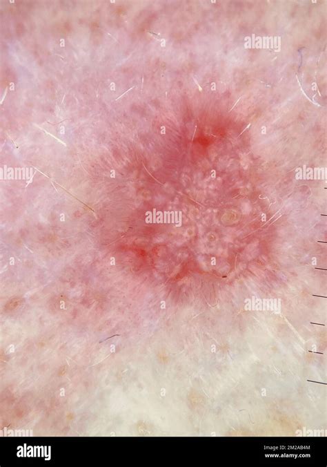 Basal Cell Carcinoma Dermoscopy Stock Photo Alamy