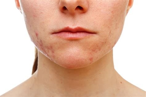 Jawline Acne Advanced Dermatology