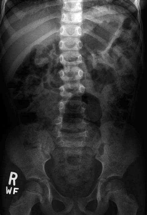 Plain Abdominal Radiograph Showing Fecal Loading Of The Large Bowel And
