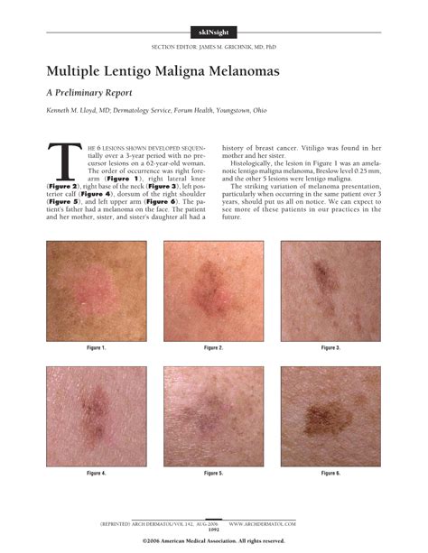 Multiple Lentigo Maligna Melanomas A Preliminary Report Dermatology
