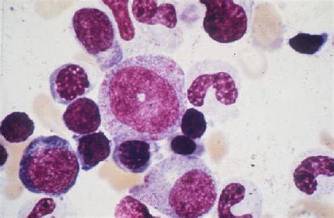 Promyelocyte