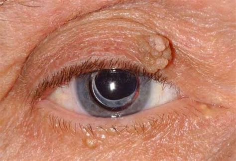 Eyelid Papilloma Wills Eye Hospital