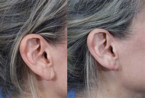 Earlobe Reduction Before And After Savannah Facial Plastic Surgery