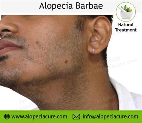 Alopecia Barbae Alopecia Areata Treatment Types Causes