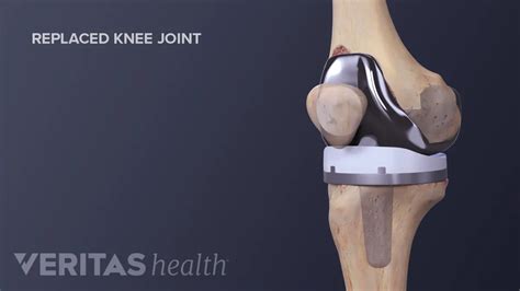 Understanding The Risks Of Knee Replacement Surgery Ask The Nurse Expert